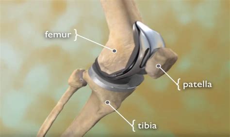 joint replacement near hercules|Total Joint Replacement .